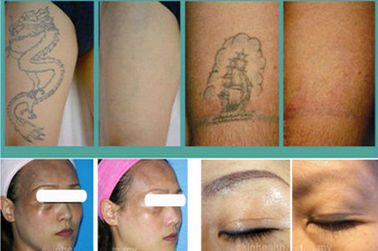 white and gray laser Spot Size 2 , 8mm Q Switched ND YAG Laser  Energy  Tattoo Remover